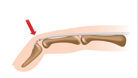 Χειρουργική επέμβαση σε σφυροδακτυλία (mallet finger)