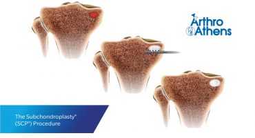 subchondroplasty