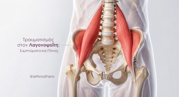Τραυματισμός στον Λαγονοψοΐτη Τραυματισμός στον Λαγονοψοΐτη απεικόνιση