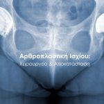 Αρθροπλαστική ισχίου και αποκατάσταση ασθενούς με τα πρώτα βήματα μετά το χειρουργείο.