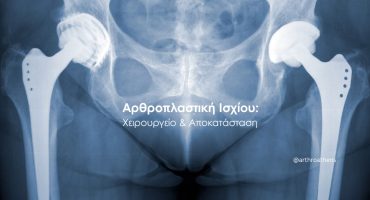 Αρθροπλαστική ισχίου και αποκατάσταση ασθενούς με τα πρώτα βήματα μετά το χειρουργείο.