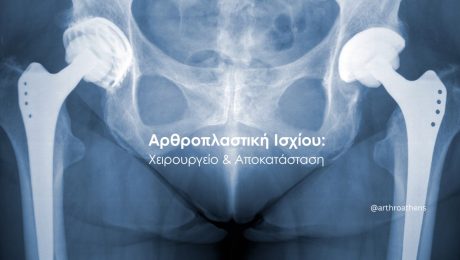 Αρθροπλαστική ισχίου και αποκατάσταση ασθενούς με τα πρώτα βήματα μετά το χειρουργείο.